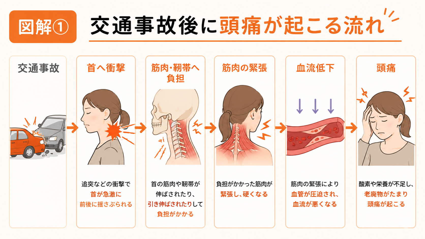 交通事故後に頭痛が起こる流れを説明した図解